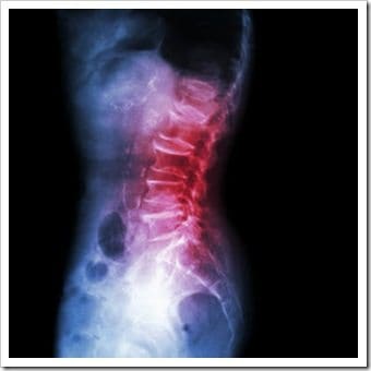 Back Pain Eatonton GA Arthritis