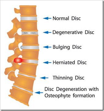 Back Pain Billings MT Arthritis