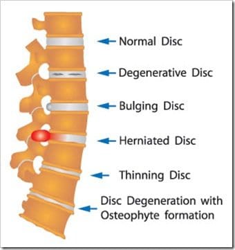 Back Pain Eatonton GA Arthritis