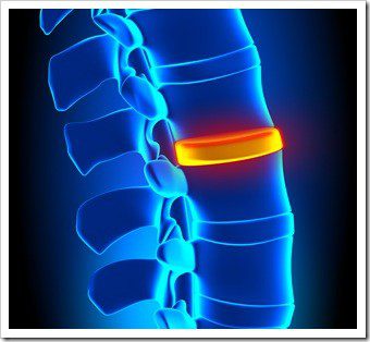 Herniated Disc and Back Pain Billings MT