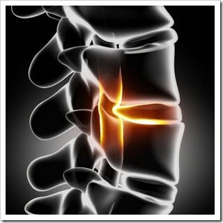 Slipped Disc Eatonton GA