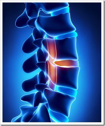 Decompression Elverson PA Low Back Pain