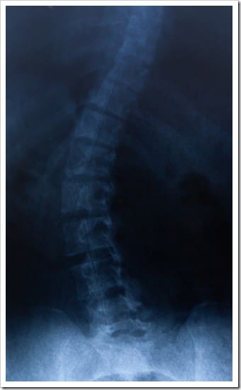Scoliosis Eatonton