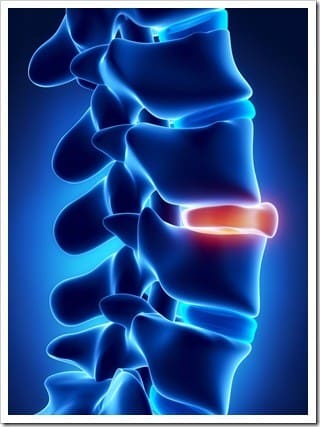 Slipped Disc Pottstown PA