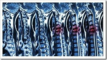 Back Pain Rehab Longmont CO Spinal Surgery